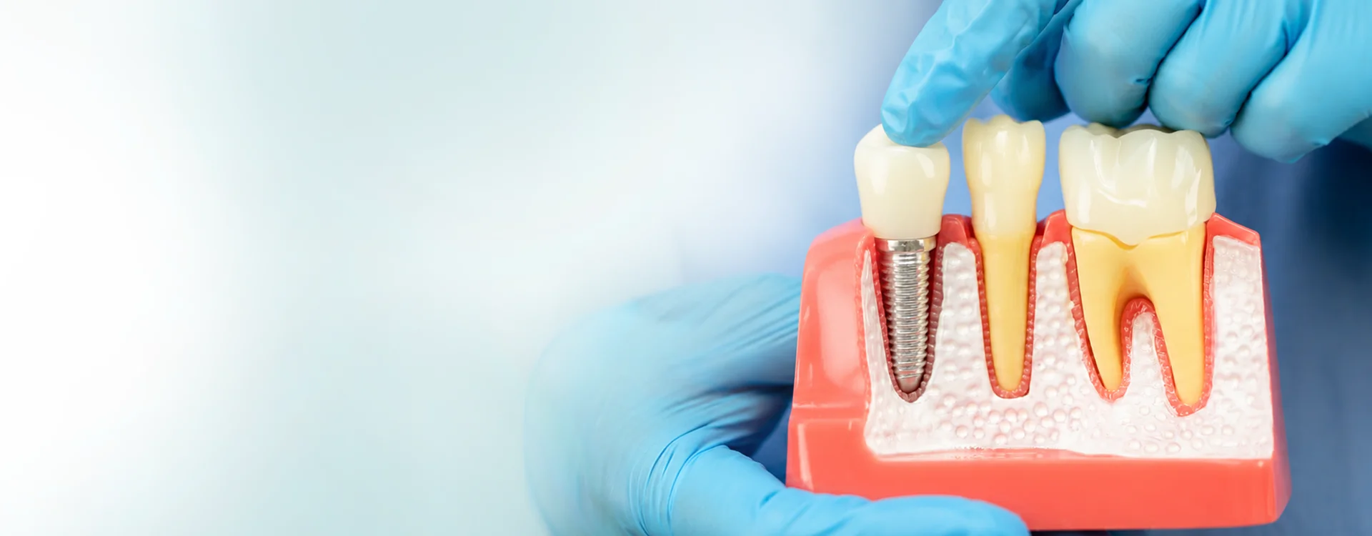 implant_banner
